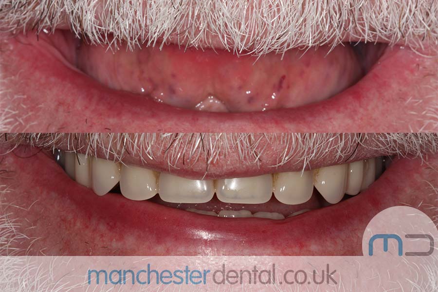 Manchester Dental same day implants Before and after Manchester Dental same day implants Before and after