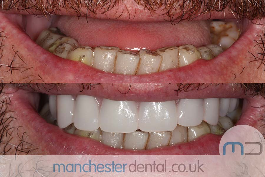Manchester Dental same day implants Before and after Manchester Dental same day implants Before and after