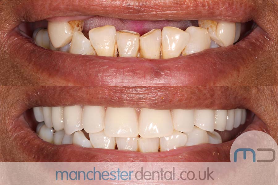 Manchester Dental same day implants Before and after Manchester Dental same day implants Before and after
