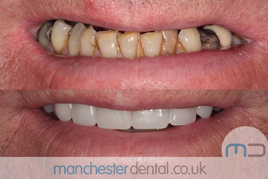 Manchester Dental same day implants Before and after Manchester Dental same day implants Before and after