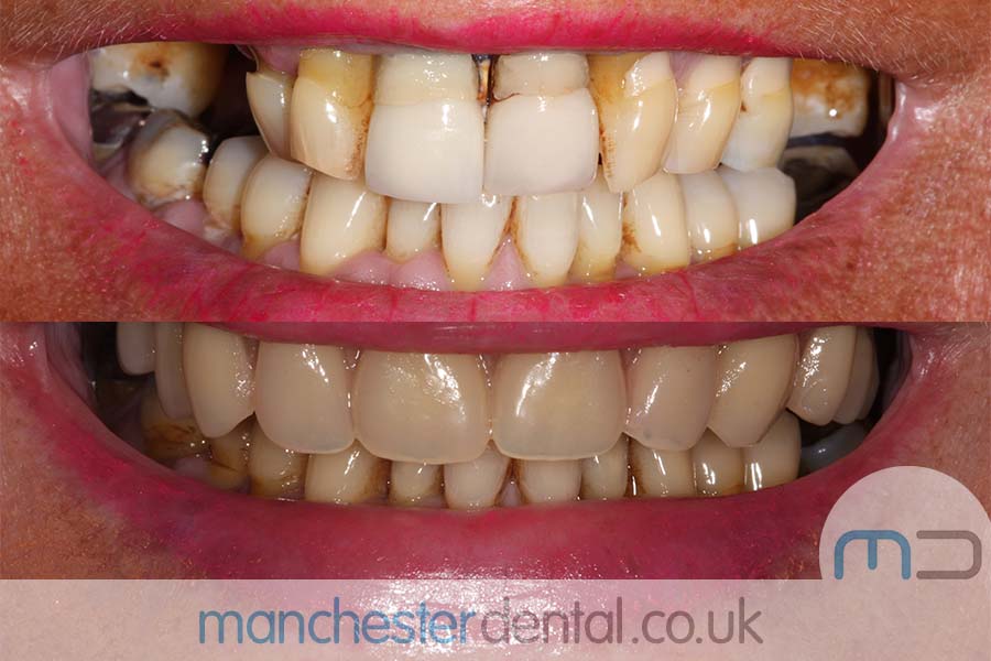 Manchester Dental same day implants Before and afterManchester Dental same day implants Before and after Manchester Dental same day implants Before and after