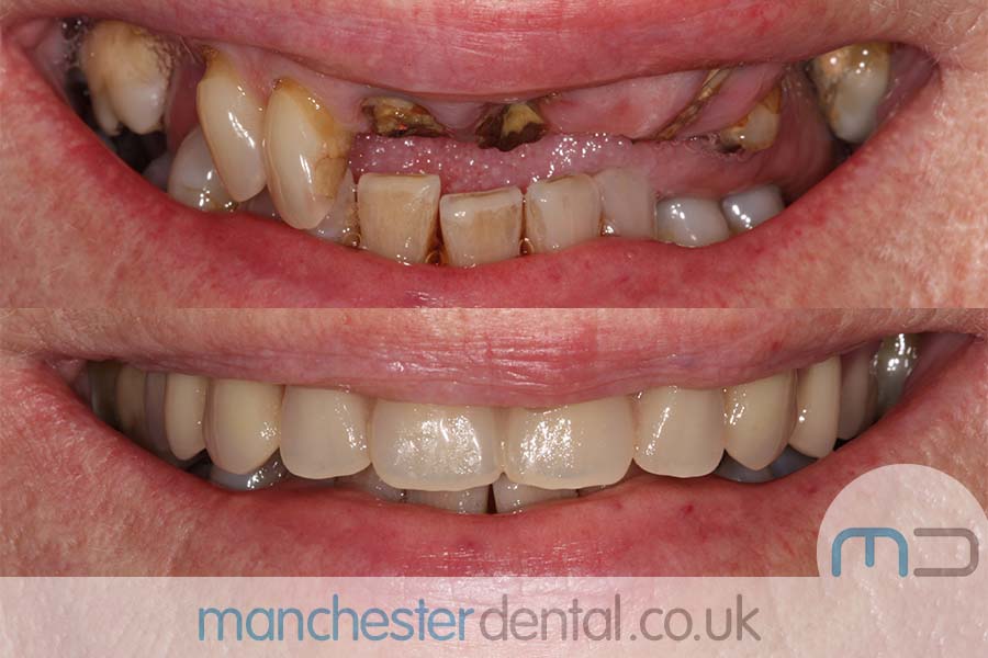 Manchester Dental same day implants Before and after Manchester Dental same day implants Before and after