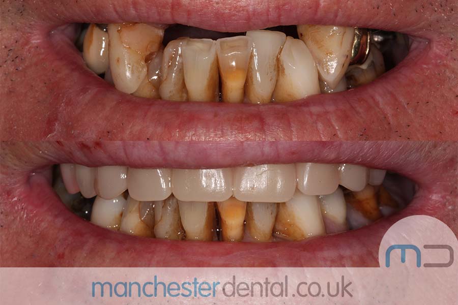 Manchester Dental same day implants Before and after Manchester Dental same day implants Before and after