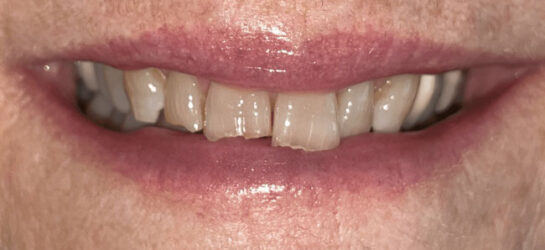 Manchester dental teeth whitening before Manchester dental teeth whitening before