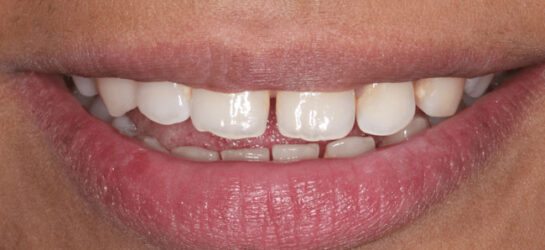 Manchester dental teeth whitening after Manchester dental teeth whitening after