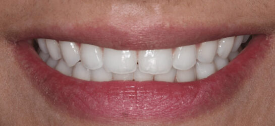 Manchester dental teeth whitening after