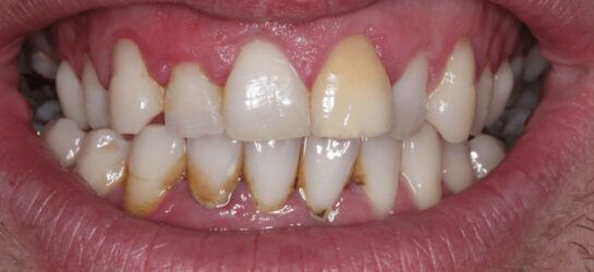 Manchester dental teeth whitening Before Manchester dental teeth whitening Before