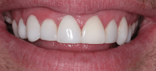 Manchester dental teeth whitening After