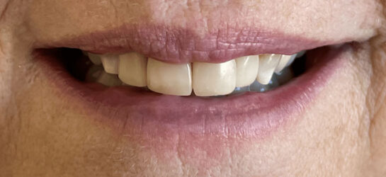 Manchester dental teeth whitening before