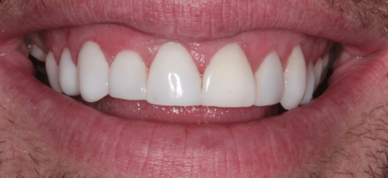 manchesterdental-composite bounding-after1