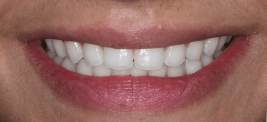 manchesterdental-composite bounding-after2