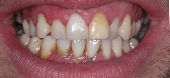 manchesterdental-composite bounding-before1 manchesterdental-composite bounding-before1