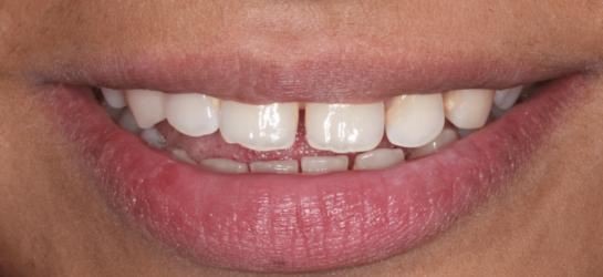 manchesterdental-composite bounding-before12 manchesterdental-composite bounding-before12