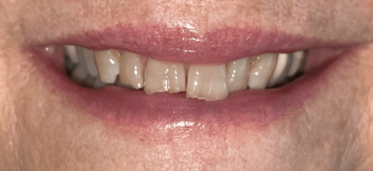 manchesterdental-composite bounding-before13 manchesterdental-composite bounding-before13