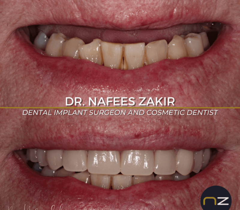 nzimplantbanda-1024x1024-1