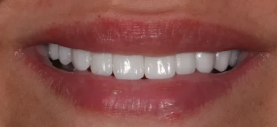 smile makeover Manchester dental after