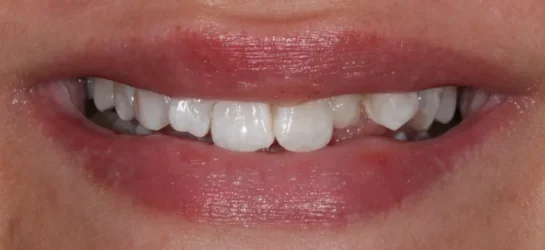 smile makeover Manchester dental before smile makeover Manchester dental before