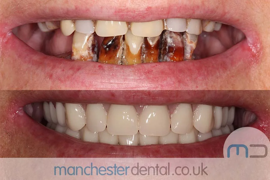 Before and after images of a dental patient's smile showing significant improvement in teeth alignment and color. Before and after images of a dental patient's smile showing significant improvement in teeth alignment and color.