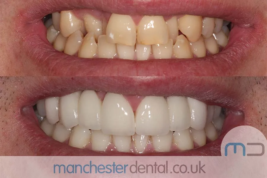 Before and after images of a dental patient's smile showing significant improvement in teeth alignment and color. Before and after images of a dental patient's smile showing significant improvement in teeth alignment and color.