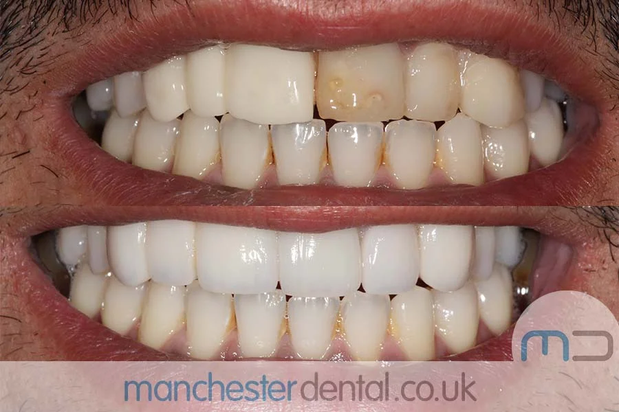 smile Before and after images of a dental patient's smile showing significant improvement in teeth alignment and color.-manchester dental gallery (2) Before and after images of a dental patient's smile showing significant improvement in teeth alignment and color.