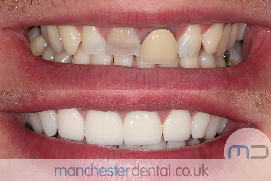smile makeover-manchester dental gallery (3) Before and after images of a dental patient's smile showing significant improvement in teeth alignment and color.