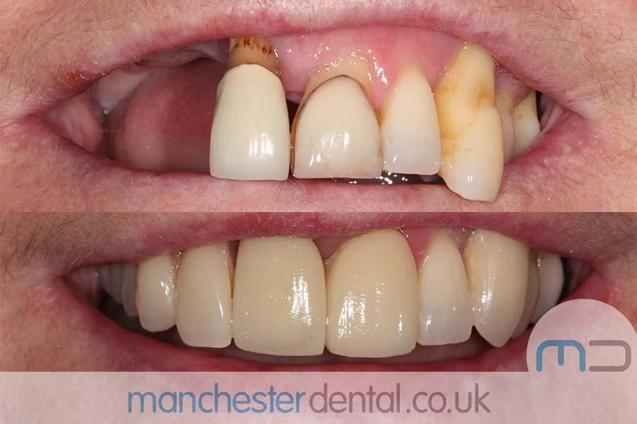 Before and after images of a dental patient's smile showing significant improvement in teeth alignment and color. Before and after images of a dental patient's smile showing significant improvement in teeth alignment and color.