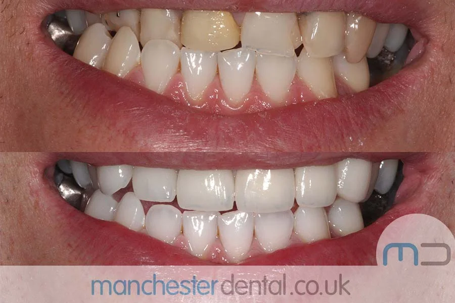 Before and after images of a dental patient's smile showing significant improvement in teeth alignment and color. Before and after images of a dental patient's smile showing significant improvement in teeth alignment and color.
