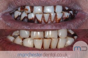 strain removal-manchester dental gallery (3) strain removal-manchester dental gallery (3)