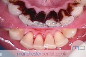 strain removal-manchester dental gallery (4) strain removal-manchester dental gallery (4)