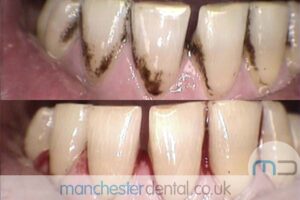 strain removal-manchester dental gallery (6) strain removal-manchester dental gallery (6)